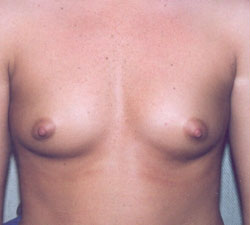 Breast Augmentation