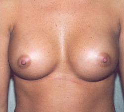 Breast Augmentation