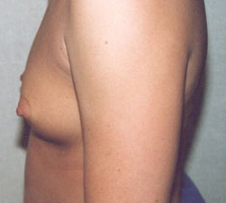 Breast Augmentation