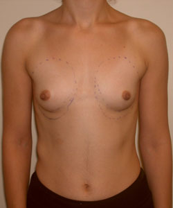 Breast Augmentation