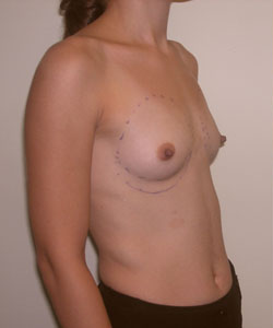 Breast Augmentation