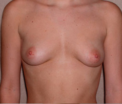 Breast Augmentation Before Photo Breast Augmentation