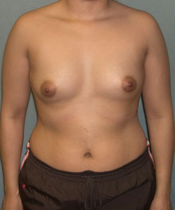 Breast Augmentation