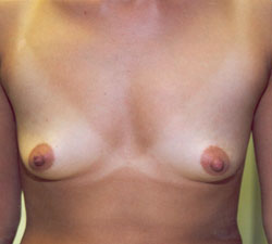 Breast Augmentation