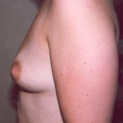 Breast Augmentation