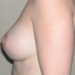 Breast Augmentation