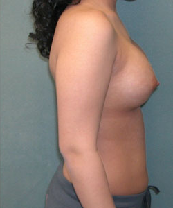 Breast Augmentation