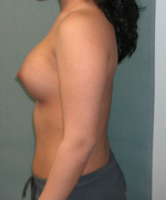 Breast Augmentation