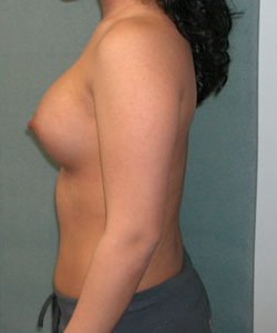 Breast Augmentation