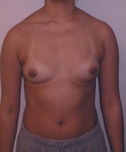 Breast Augmentation