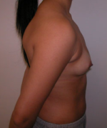 Breast Augmentation