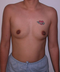 Breast Augmentation