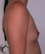 Breast Augmentation