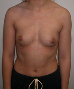 Breast Augmentation Before Photo Breast Augmentation