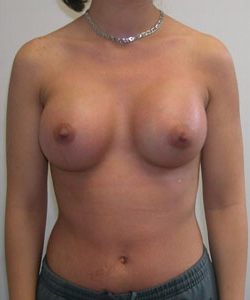 Breast Augmentation After Photo Breast Augmentation