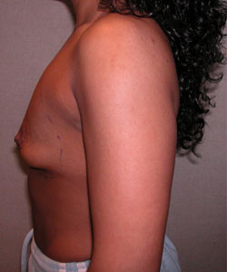 Breast Augmentation