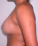 Breast Augmentation