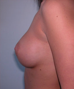 Breast Augmentation