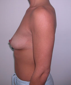 Breast Augmentation