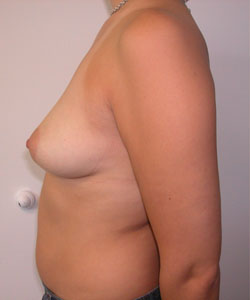 Breast Augmentation