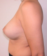 Breast Augmentation