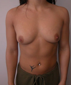 Breast Augmentation Before Photo Breast Augmentation
