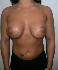 Breast Augmentation After Photo Breast Augmentation
