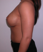 Breast Augmentation