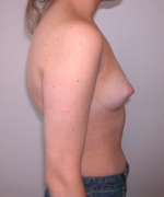 Breast Augmentation