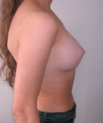 Breast Augmentation