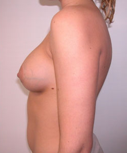 Breast Augmentation