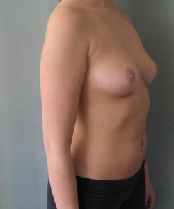 Breast Augmentation