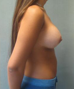 Breast Augmentation