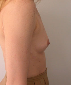 Breast Augmentation