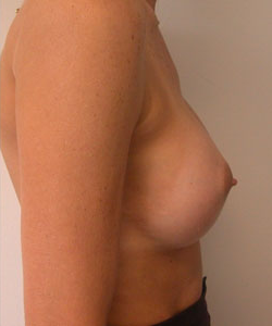 Breast Augmentation