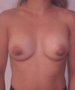 Breast Augmentation