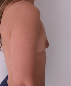 Breast Augmentation