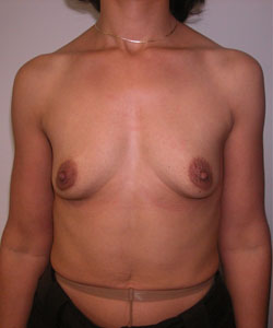 Breast Augmentation