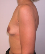 Breast Augmentation