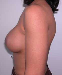 Breast Augmentation