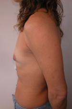 Breast Augmentation