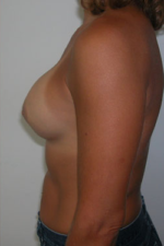 Breast Augmentation