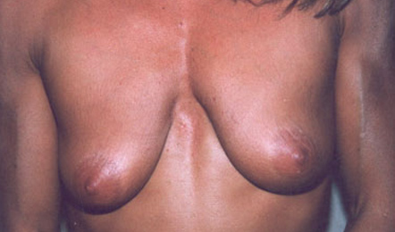 Breast Augmentation Before Photo Breast Augmentation