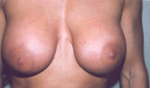 Breast Augmentation