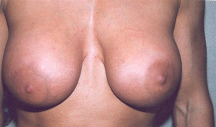 Breast Augmentation After Photo Breast Augmentation