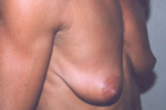 Breast Augmentation