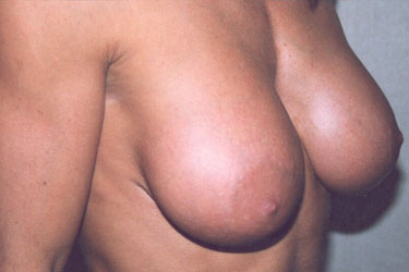 Breast Augmentation