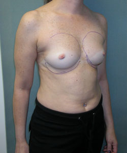 Breast Augmentation