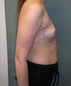 Breast Augmentation