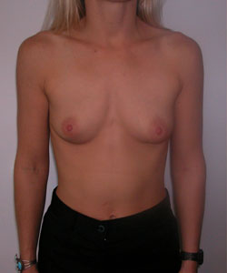 Breast Augmentation Before Photo Breast Augmentation